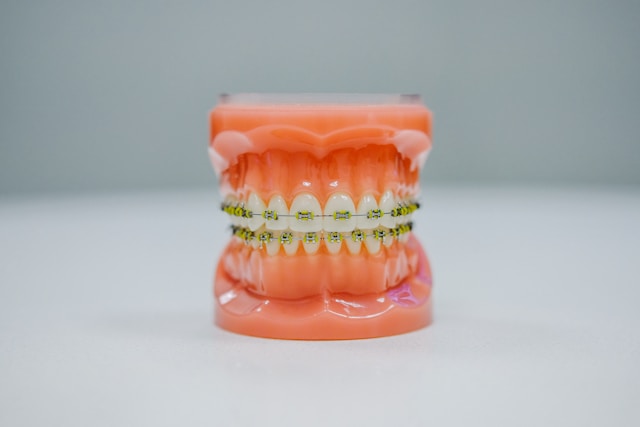 Read more about the article Jenis-Jenis Behel Yang Bisa Anda Pilih Pada Promosi Behel Gigi, Ternyata Ga Cuma Satu!